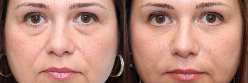 Pred a po blefaroplastike - odstránenie tukového telesa pod očami a napnutie kože