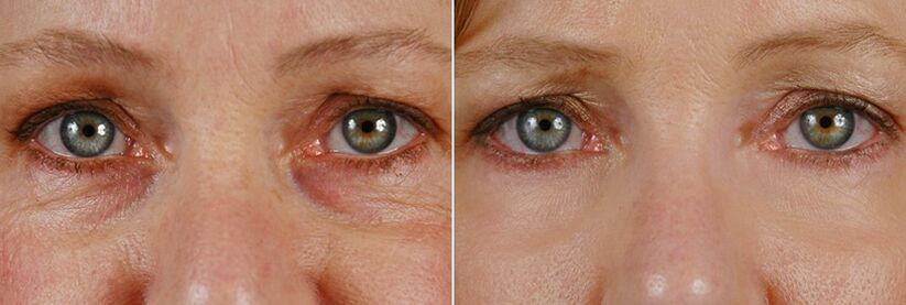 Pred a po laserovej operácii - omladenie pokožky okolo očí